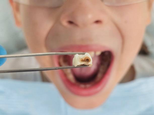 Best Emergency Dental Care for Broken or Chipped Teeth in Lake Hiawatha, NJ