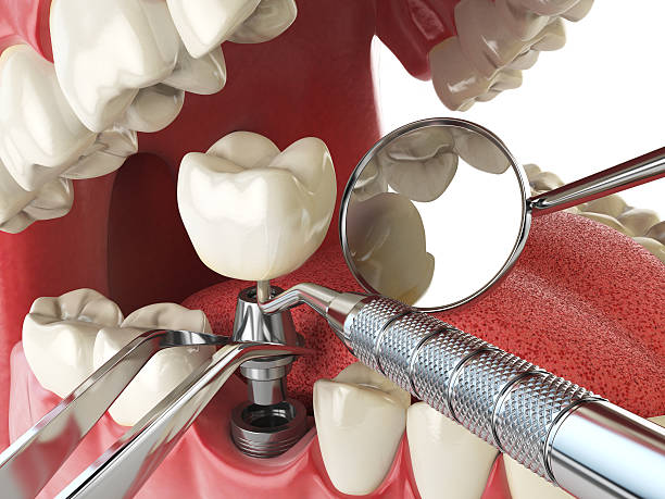 Best Emergency Dental Care for Broken or Chipped Teeth in Lake Hiawatha, NJ